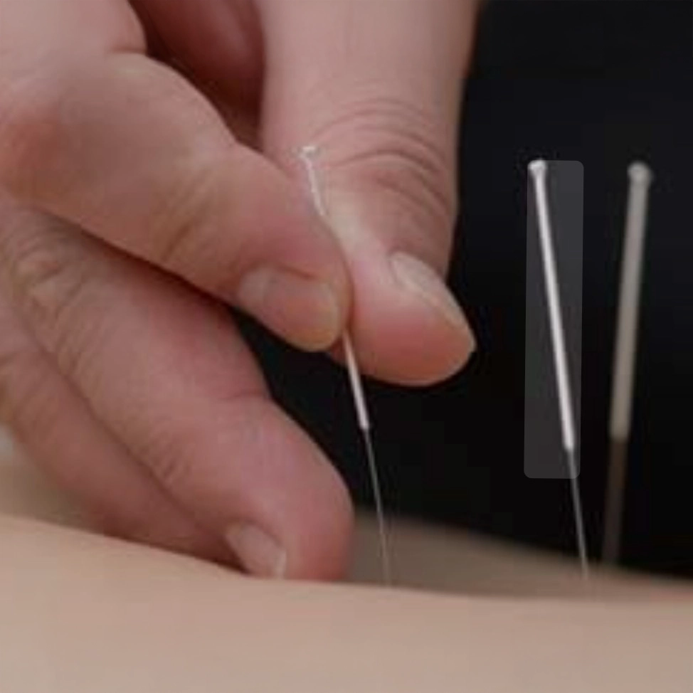 Acupuncture