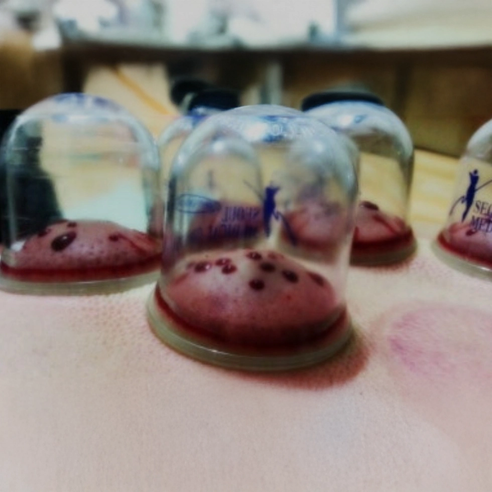 Cupping